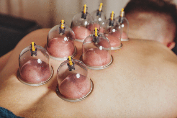 Blood Cupping | 15min